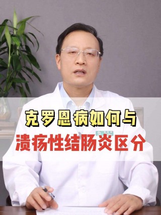 克罗恩病和溃疡性结肠炎有什么区别(克罗恩病和溃疡性结肠炎哪个比较严重)